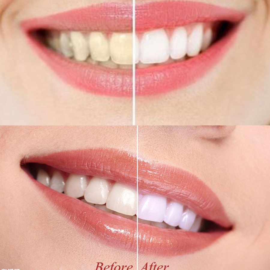 Denti di carbone di bambù dent - Teeth Whitening Kit recensione e prezzo