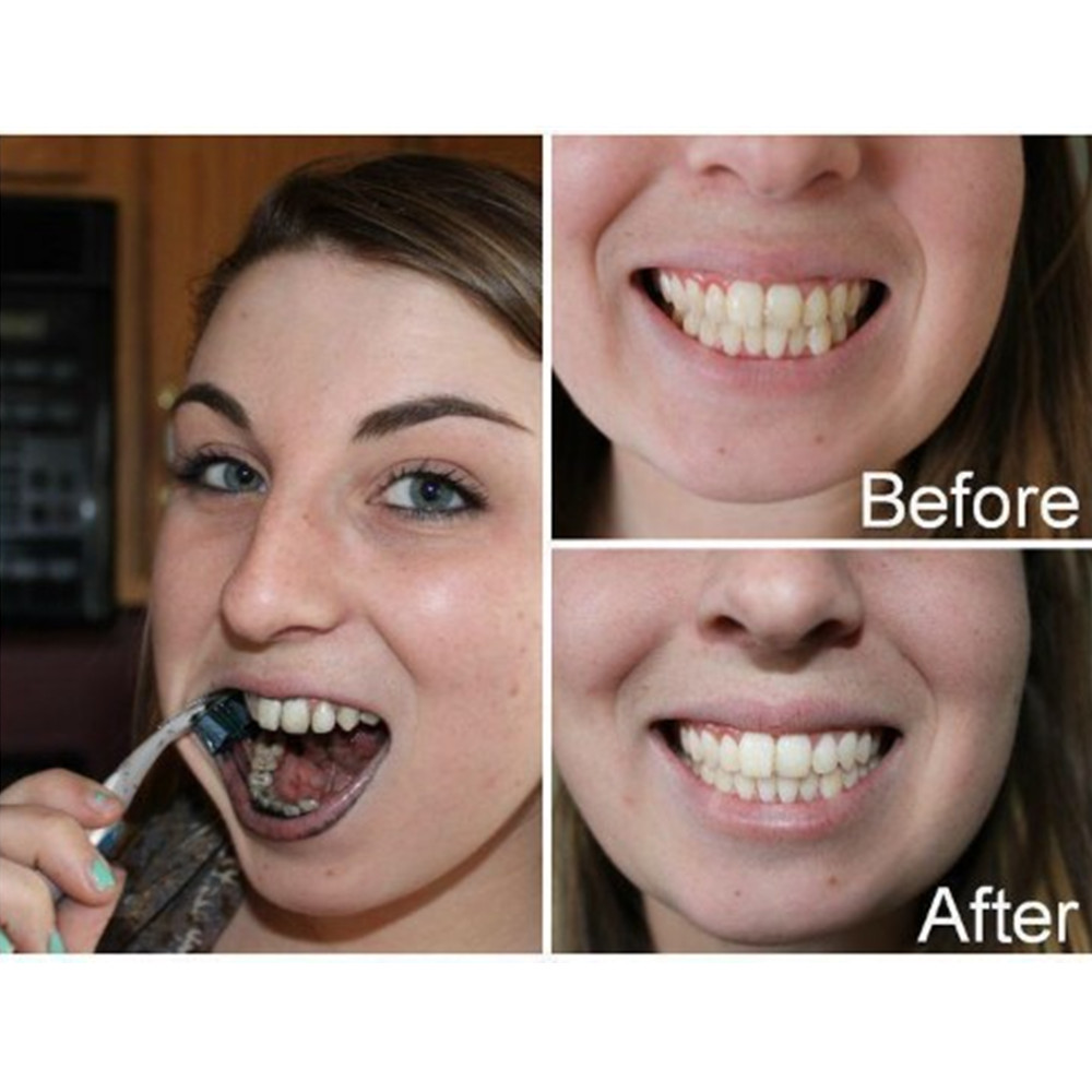 Denti di carbone di bambù dent - Teeth Whitening Kit recensione e prezzo