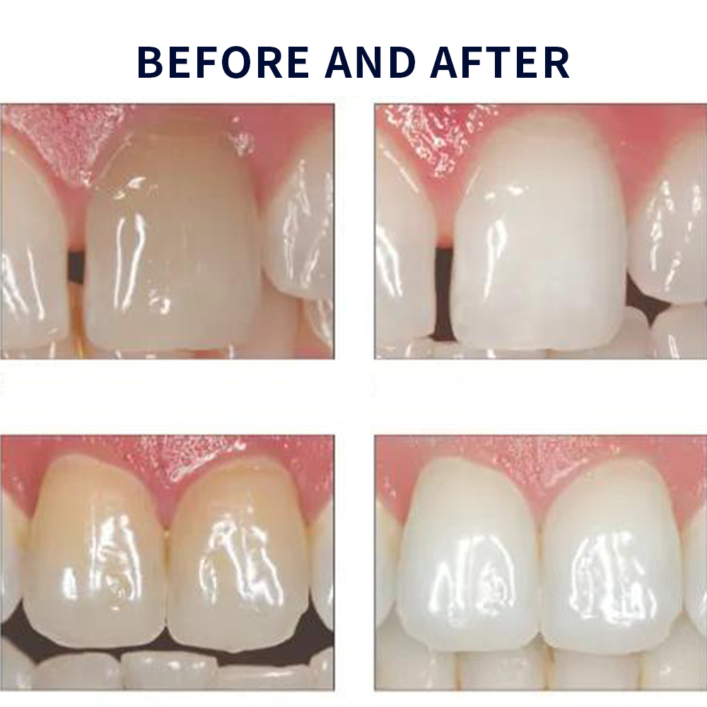 Opalescence Whitening 20% PF 2 - Teeth Whitening Kit recensione e prezzo
