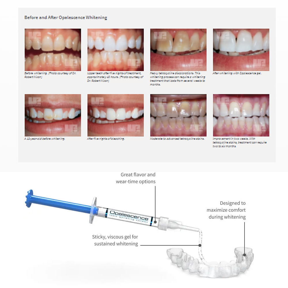 Opalescence Whitening 20% PF 2 - Teeth Whitening Kit recensione e prezzo