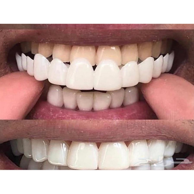 Morbido Gel di Silicone Dental - Teeth Whitening Moulds recensione e prezzo