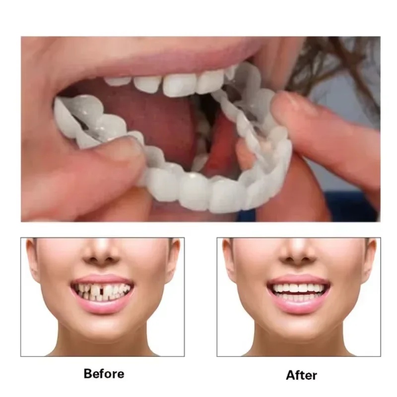 Kit di Denti in Impiallacciatu - Teeth Whitening Kit recensione e prezzo